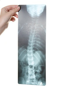 image of chiropractic xray with scoliosis