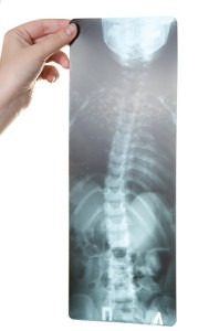 Scoliosis may be treated with Chiropractic image of chiropractic xray with scoliosis